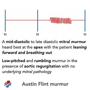 Life In The Fast Lane (LITFL) on Instagram: "TURN ON SOUND Austin Flint Murmur: Mid diastolic, low pitch rumble murmur heard best at the apex with the patient leaning forward and breathing out The absence of an opening snap and loud S1 distinguishes the pure aortic regurgitation of an Austin flint murmur from that of mitral stenosis An ECG may show a sinus rhythm with left ventricular hypertrophy, left axis deviation and prolonged PR interval. Mechanism: Occurs in aortic regurgitation as a resul