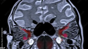 High-resolution coronal MRI of the human head displaying brain anatomy and highlighted temporomandibular joint area