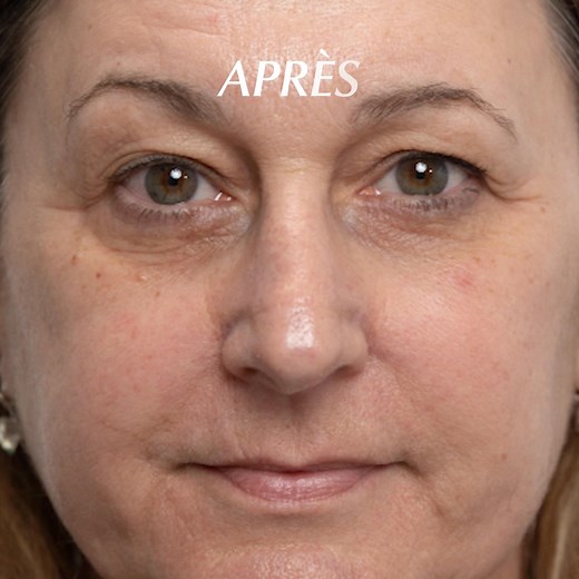 Découvrez nos AVANTS/APRES du traitement Renew Cellular: Rajeunit l’âge biologique de la peau et inverse les effets du vieillissement cutané. Clinique de Longévité Cible Skin 31 rue François 1er, Paris 8. 33(0)144136130 | Cible Skin