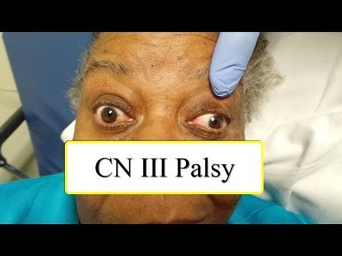 CN III Palsy • Video • MEDtube.net