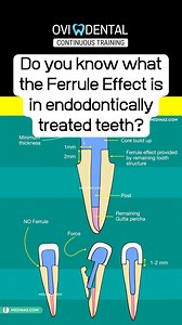 🚫 Do you know what the Ferrule Effect is in endodontically treated teeth? #FerruleEffect #Endodontics #Ovidental | OVIdental Go