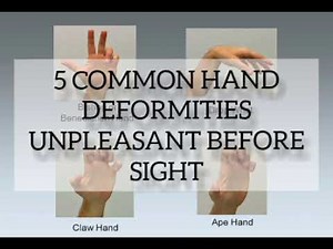 5 Common hand deformities unpleasant before sight