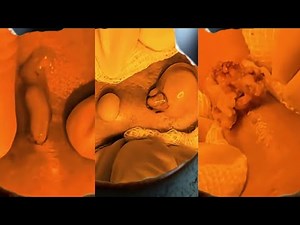 Most Satisfying Pimple Popping & Blackhead Removal Compilation | Oddly Relaxing ASMR 111