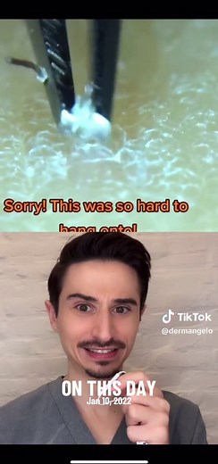 HUGE Ingrown Hair Extraction on This Day