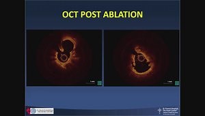 Diamondback 360 Coronary Orbital Atherectomy System