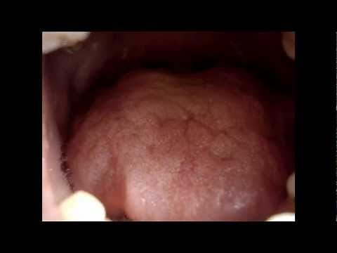 Tongue Fasciculation, Motor Neuron Disease. Osama SM Amin FACP & Saad S Shwani MD