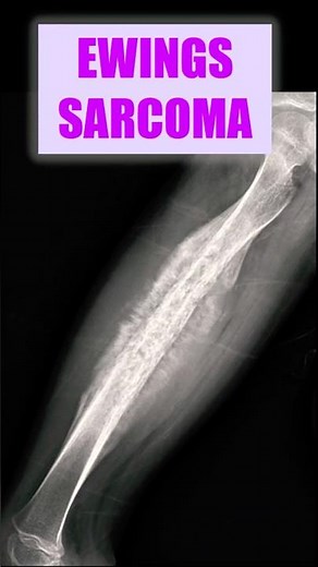 Ewing’s Sarcoma on X-Ray – Classic Radiologic Signs #xray, #radiology, #sarcoma
