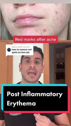 How to Get Rid of Red Spots on Face - Quick Tips and Treatments