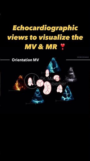 Mitral valve imaging, Barlow's disease & MR in echocardiography ❣️
