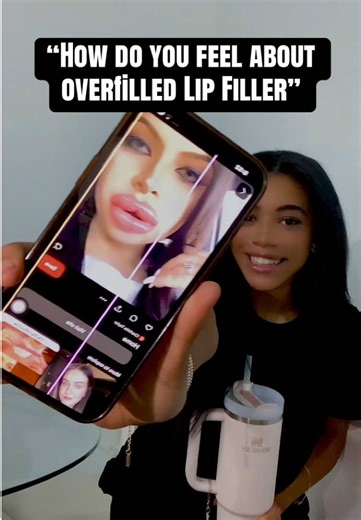Understanding Overfilled Lip Fillers: Expert Q&A