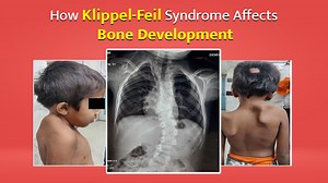 What Is Klippel-Feil Syndrome? How It Affects Neck Bone Development