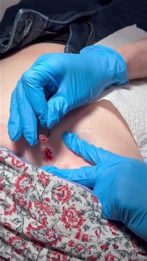 Skin tag removal: quick, easy, and done in minutes ✂️✨