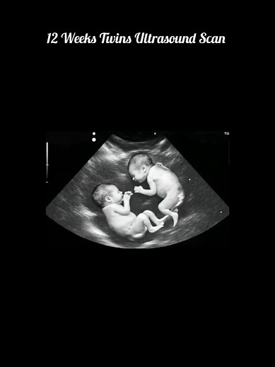 12 Weeks Twins Ultrasound Scan #ultrasound #pregnancy #baby #mothers #babyinwomb