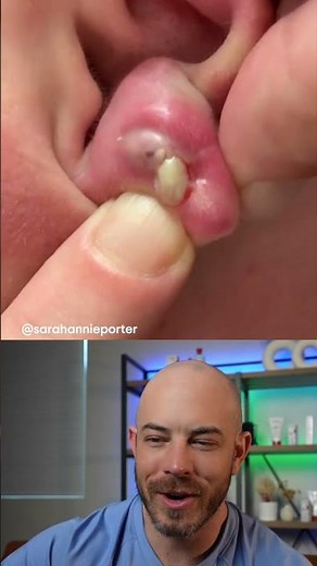 Doctor reacts to foul infected piercing pop! #earpiercing #pimplepop #infection