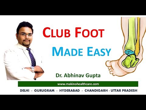 Congenital Talipes Equinovarus Varus (CTEV) - Club foot - Made easy with Dr. Abhinav Gupta