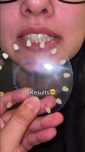 🦷The Snow Diamond Teeth Whitening Wired Kit gives you dentist-level results in just minutes a day