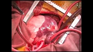 M - Surgical repair of complete atrioventricular defect - Nunn technique