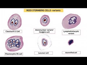 Reed Sternberg Cells Seen in Hodgkin's Lymphoma