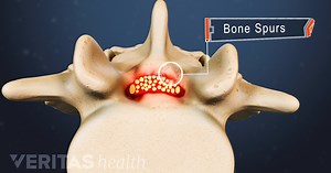 Bone Spur Causes