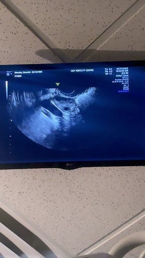 Egg Stimulation and Retrieval Process Explained