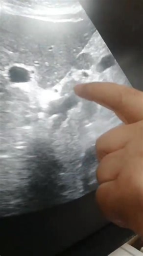 Porta hepatis adenopathy | إستشاري امراض الباطنة والكبد د محمد الجمال