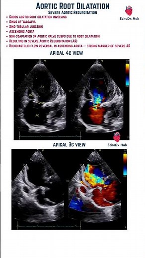 Massive Aortic Root Dilatation with Severe Aortic Regurgitation #echocardiography