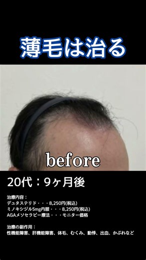【20~50代男性】AGA治療での変化。#薄毛 #AGA #新宿