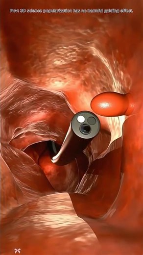 No Surgery Needed — Colon Polypectomy Explained! Medical animation #colonpolypectomy #colonoscopy