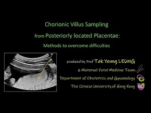 CVS from Posteriorly located Placentae: Methods to overcome difficulties | OBG CUHK