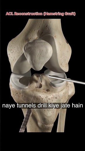 ACL Reconstruction (Hamstring Graft) ‪@IamMedicodp‬ #orthopedics #humananatomy #anatomy #nurse