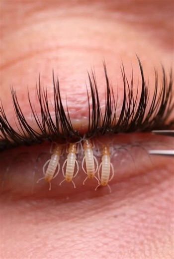 Removing Demodex Mites for Oddly Satisfying Relief