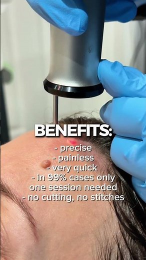 Mole Removal at Rejuvena UK | Safe, Expert Treatment ✨