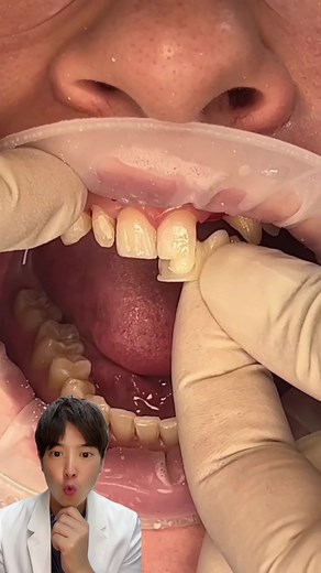 front tooth #dentist #ceramic #directbonding