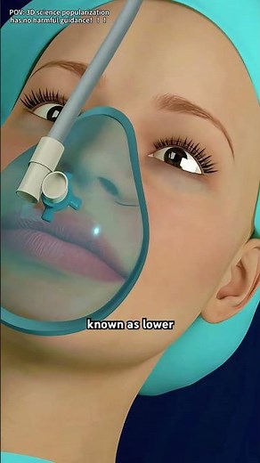 Transcutaneous Lower Blepharoplasty Procedure (3D Animation)#blepharoplasty