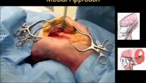 Approaches to the Distal Femur