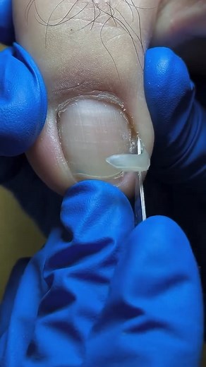 2.3M views · 16K reactions | Removing Deep Ingrown Toenail | Ingrown Toenails | Facebook