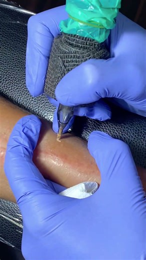 Medical tattooing in India ! Surgery scar cover up