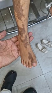 Incontinentia pigmenti, a rare Neurocutaneous disorders | Dr. Arshad Mehmood - Child Specialist