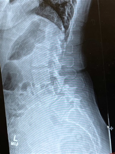 Managing Pain from Lumbar Spine Issues