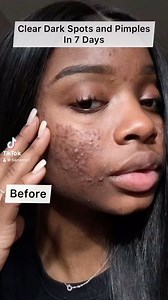 817K views · 9.9K reactions | Get rid of pimples and dark spots | Tiana | Facebook
