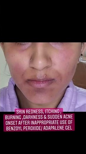 Side effects of inappropriate application of Benzoyl Peroxide | Adapalene gel #shorts