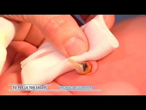 Cura del cordone ombelicale del neonato