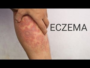 Eczema -Incidence,Causes,Symptoms, Diagnosis,Treatment,Prevention, Complications|Nursing Management|