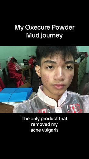 Say Goodbye to Acne Vulgaris with My Oxecure Powder
