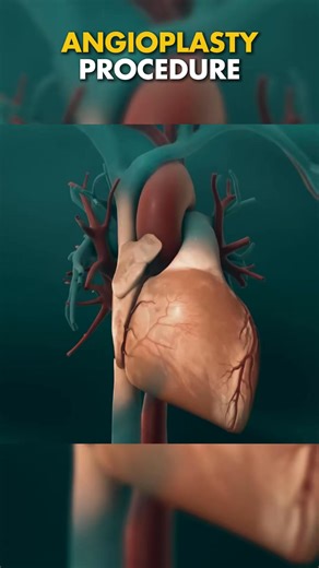 Angioplasty Procedure #medical #animations #medical3d #3dmedicalanimation #medicalanimation3d #iud #zackdfilms #zack #animation #heart #angioplasty #stent | Mix Dancing Events