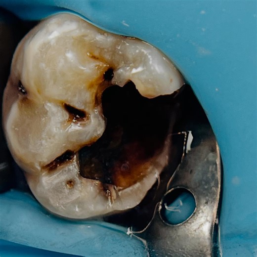 dr_assem salah | Direct pulp capping 🖤 | Instagram