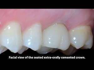 Immediate Placement and Restoration of a Maxillary First Molar with an Extra-Orally Cemented Crown