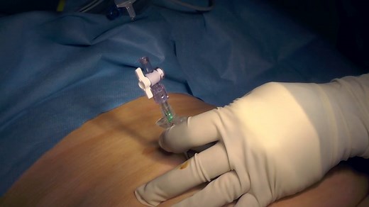 Closed laparoscopic entry technique