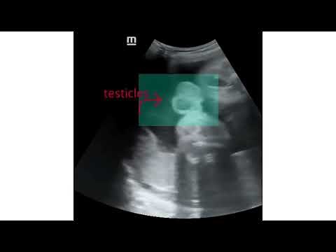 The Turtle sign ultrasound for baby boys |