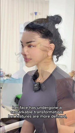 ⭐WATCH HER FACE TRANSFORM | DR LIAM VU DEEP PLANE FACELIFT⭐